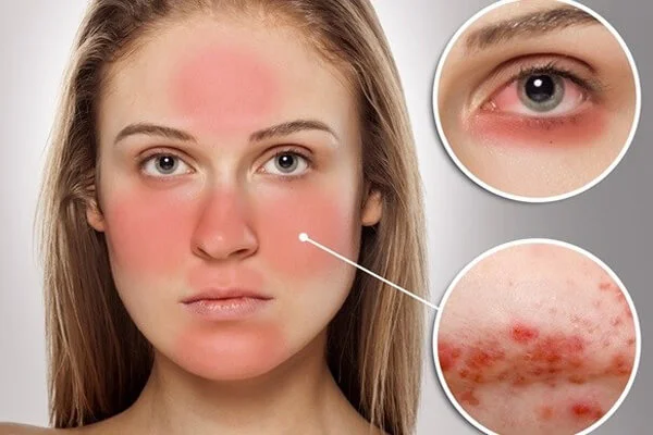 lupus-ban-do